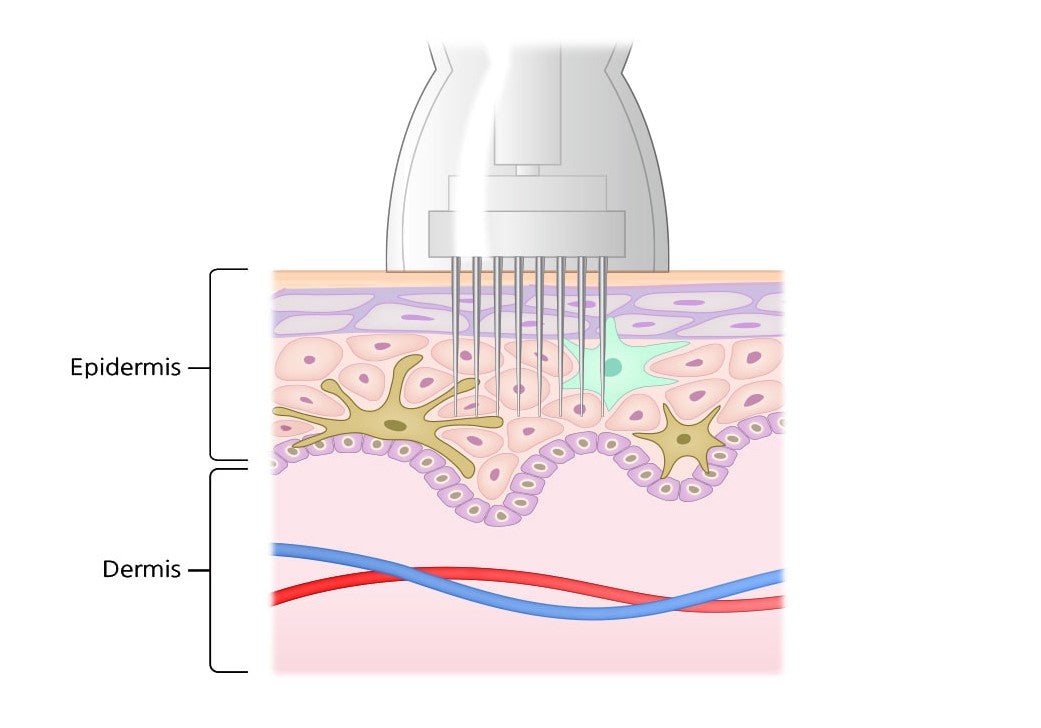 Microneedling Microbiome+Gold