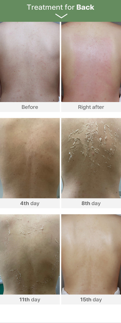 Medisco Peelings S-Deep Peel-Programm + inklusive Heimpflegeprodukten