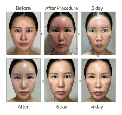 Medisco Peelings S-Deep Peel-Programm + inklusive Heimpflegeprodukten